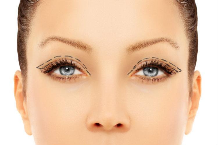 What is Eyelid Surgery (Blepharoplasty)? - Southwestern Eye Center