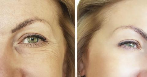 face wrinkles before and after eyelid surgery