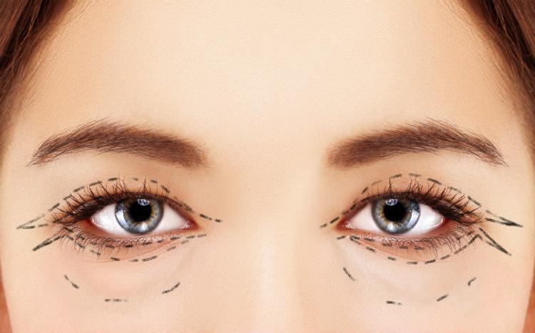 lower eyelid and upper eyelid blepharoplasty markings on face, cosmetic eyelid surgery