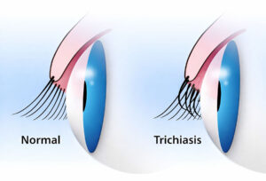 Medical illustration comparing normal eyelashes with trichiasis where lashes turn inward and rub the eye, used to explain common eye infections and irritation, Find treatment today at Southwestern Eye Centers