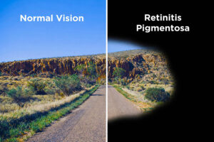 Split comparison image showing a desert road with normal vision on the left and a dark tunnel effect on the right representing retinitis pigmentosa, illustrating how peripheral vision loss can look in an educational graphic from Southwestern Eye Center