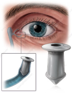 Diagram depicting punctal plugs as a dry eye medication at Southwest Eye Center.