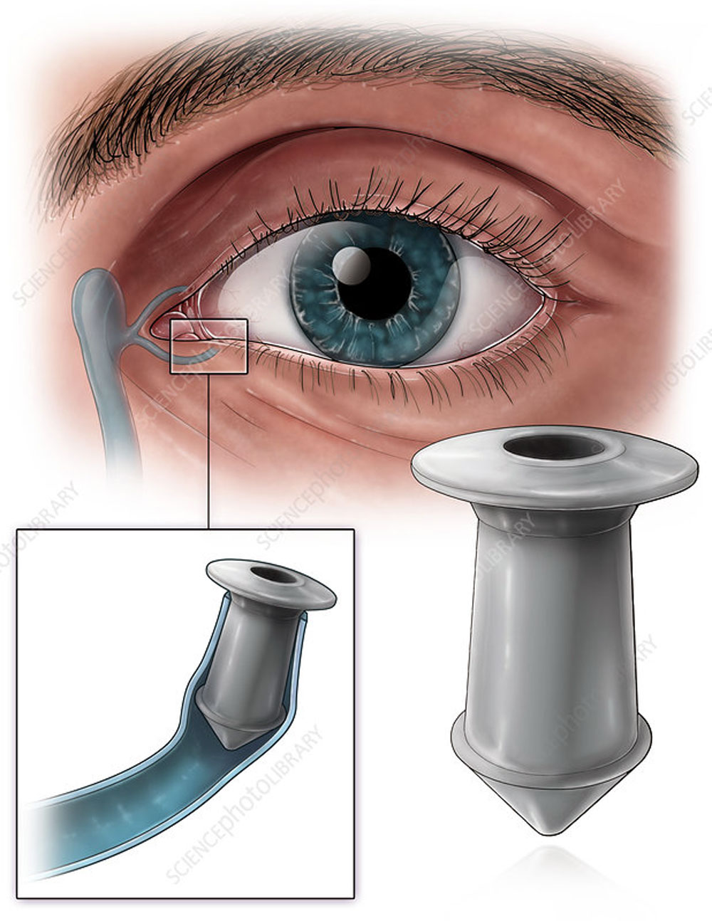 Dry Eye Treatment in Arizona | Southwestern Eye Center