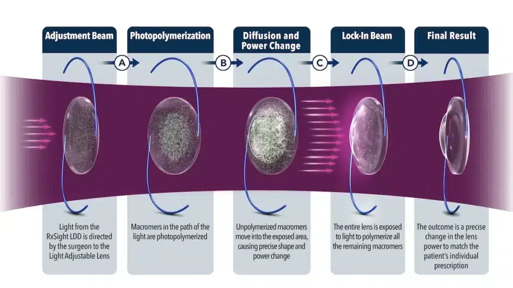 Graphic showing how the light treatments are performed