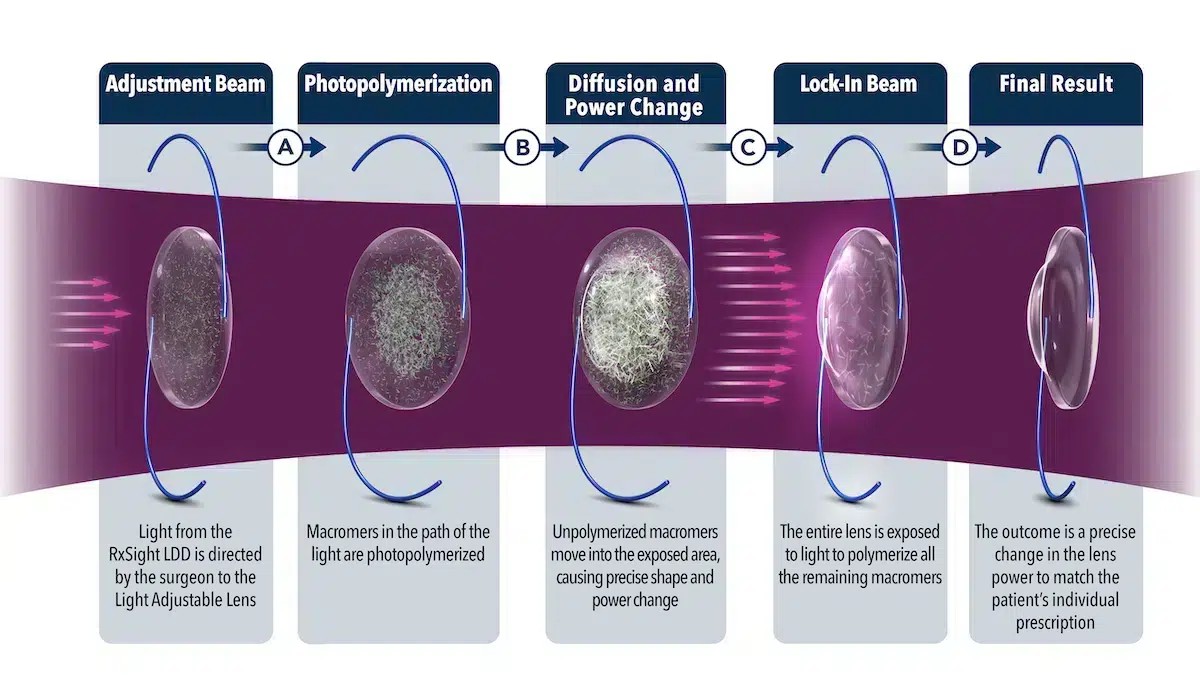 Graphic showing how the light treatments are performed