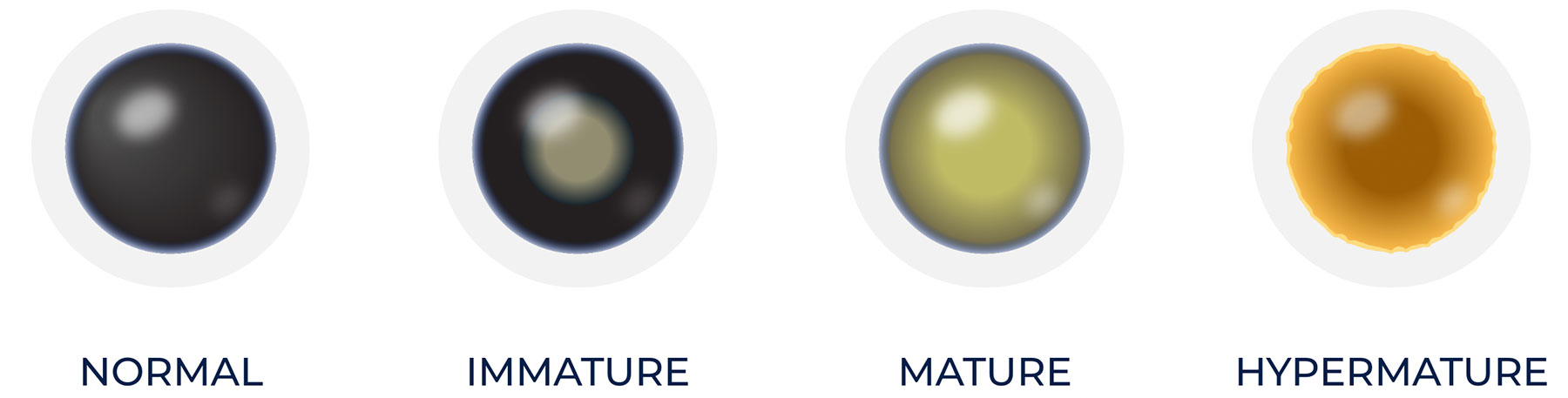 Four circular samples in a row labeled Normal, Immature, Mature, and Hypermature.