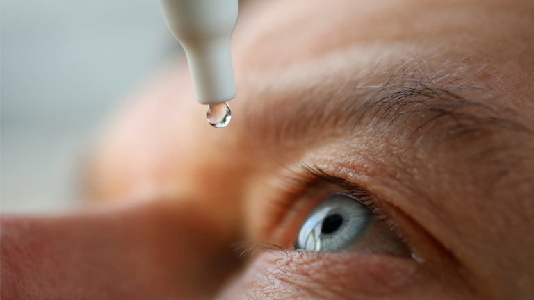 Image of a patient that uses glaucoma drops daily to prevent elevated intraocular pressure.