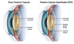 Southwestern Eye Center illustration comparing a clear posterior capsule with posterior capsular opacification behind an intraocular lens.