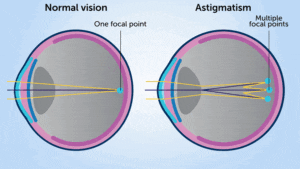 Astigmatism diagram explained by Southwestern Eye Center.