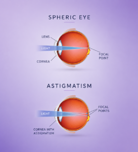 Astigmatism graphic for Southwestern Eye Center.